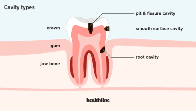 how to know if you have cavities
